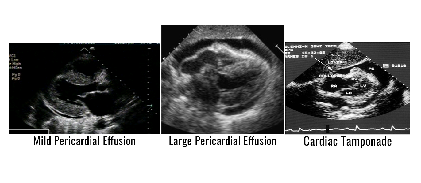 Echocardiography Assessment of Pericardial Effusion and Cardiac Tamponade