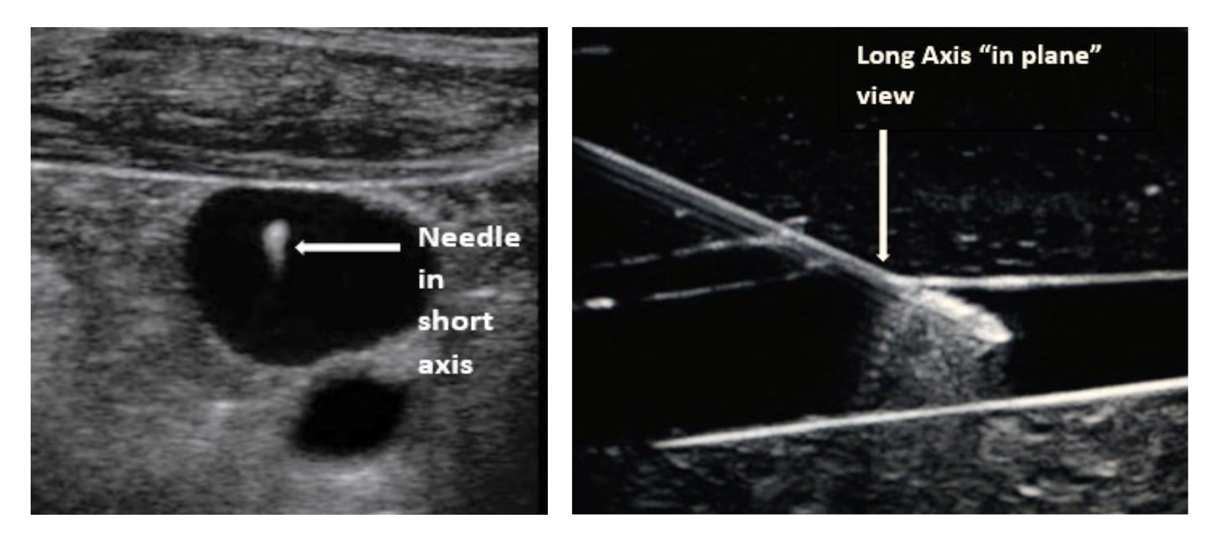 <strong><h1>Benefits of Ultrasound Guidance when used to aid in central venous, peripheral venous, or arterial access. </strong></h1>