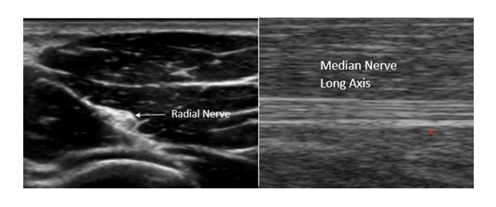 Ultrasound of Peripheral Nerves: Understanding System Optimization and Basic Physics Will Help with The Learning Process