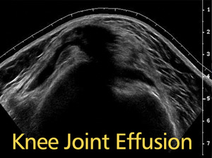 knee effusion ultrasound