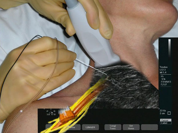 Ultrasound-guided Regional Anesthesia
